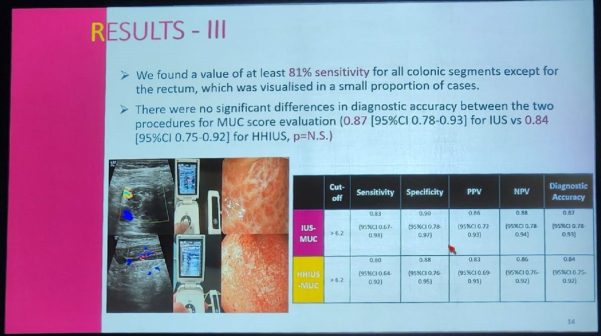 Michael Chiorean (@mchiorean4) on Twitter photo Rispo - hand-held ultrasound HHUS vs. conventional #IUS in 86 UC #colitis patients with mod-severe c/scope activity: good correlation btw the 2 techniques for standard parameters, i.e. BWT, stratification, echogenicity. Another tool for objective POC #IBD assessment #DDW2023 Rispo - hand-held ultrasound HHUS vs. conventional #IUS in 86 UC #colitis patients with mod-severe c/scope activity: good correlation btw the 2 techniques for standard parameters, i.e. BWT, stratification, echogenicity. Another tool for objective POC #IBD assessment #DDW2023