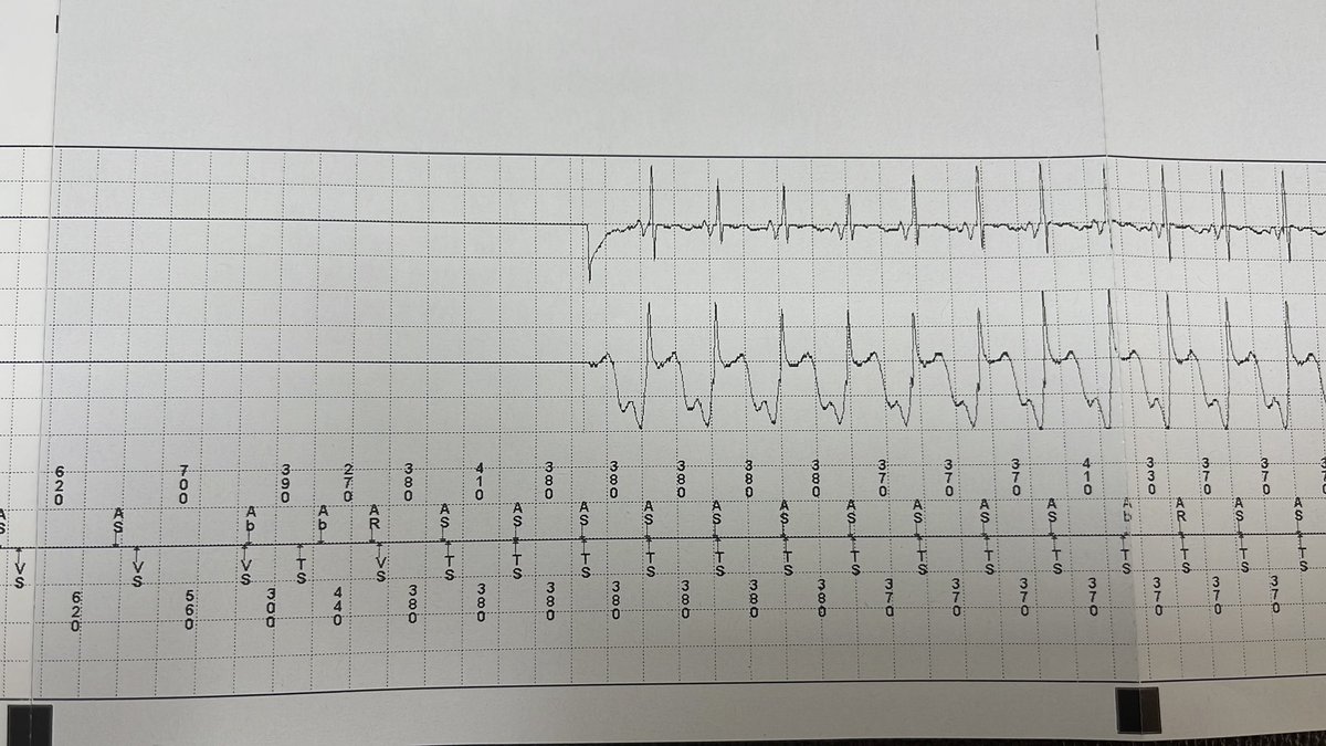 NjeimMario's tweet photo. @DrGregMichaud This device decided to become an EPist.. tracings from my clinic 2 days ago.. atypical initiation for SVT (same initiation seen several times), wavelet was no match with nice response to ventricular pacing and termination with 2nd ATP https://t.co/Ch9ln6aVIi