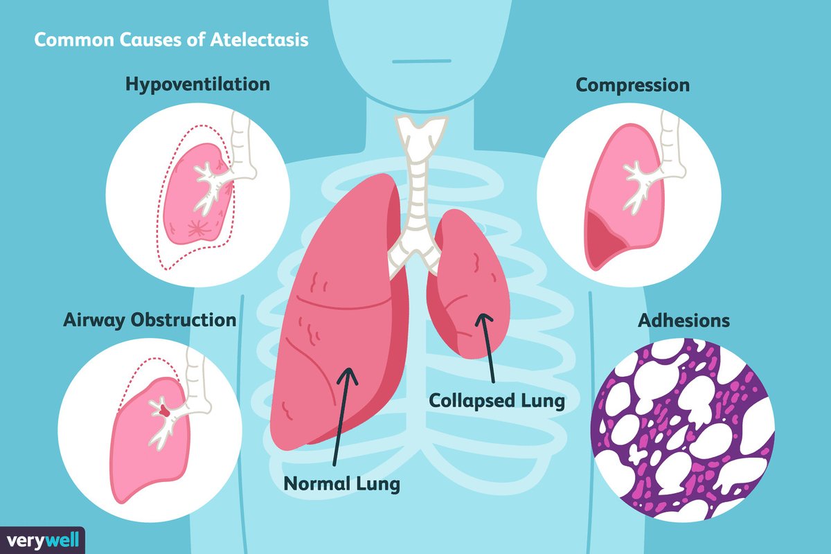 UHAsthma's tweet photo. A complication of asthma-lung atelectasis. A condition in which one lung is excluded from gas exchange.
There is severe breathlessness and the pain is very severe. The body temperature rises and the pulse rate increases. If the blood pressure drops, shock occurs.
#asthmaproblems https://t.co/MhxtR7VRG6