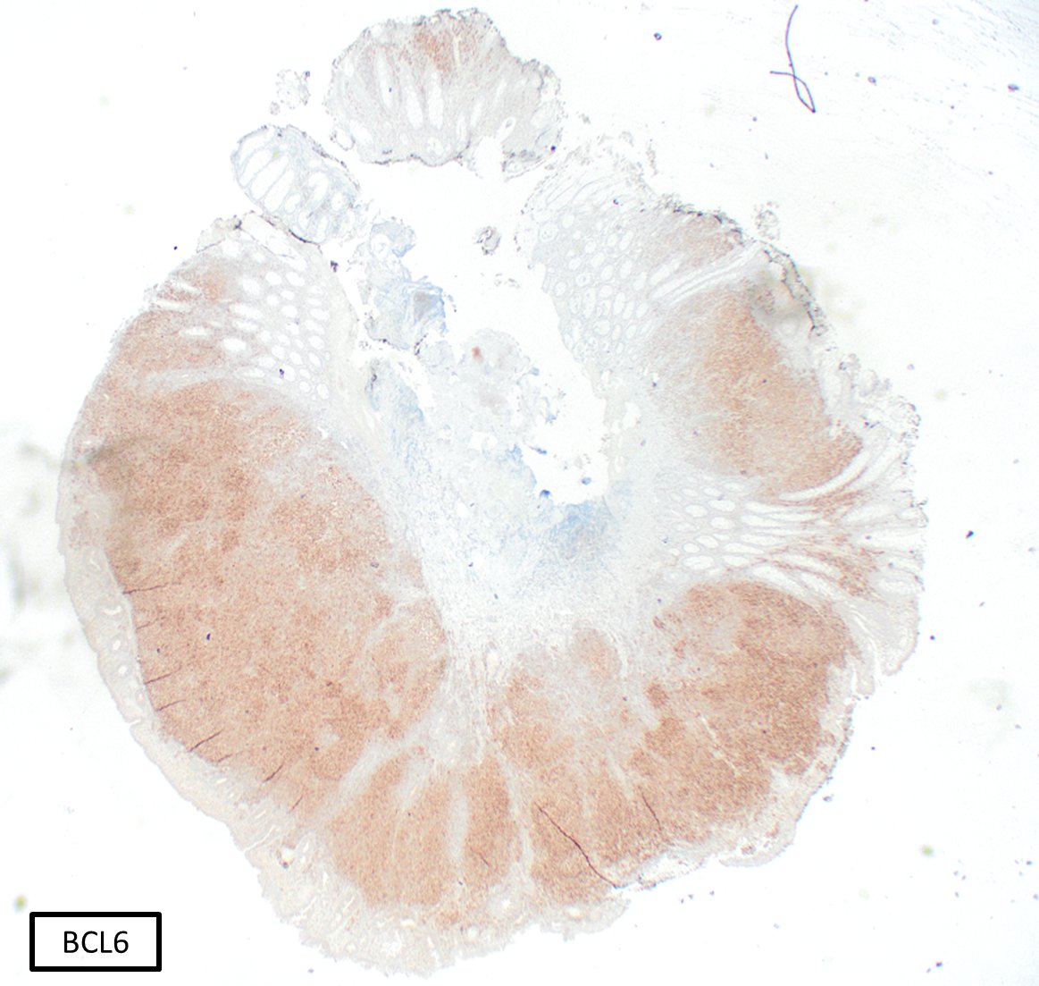 SibaElHussein's tweet photo. Follicular lymphoma, duodenal type➡️Follicular dendritic cell meshworks (CD21/CD23/CD35+) are pushed to the periphery of the neoplastic follicles (“HOLLOW” meshworks), in contrast to preserved meshworks usually seen in nodal/systemic FL #hemepath #pathtwitter #lymsm #MedTwitter https://t.co/fWxz4CZ1GM