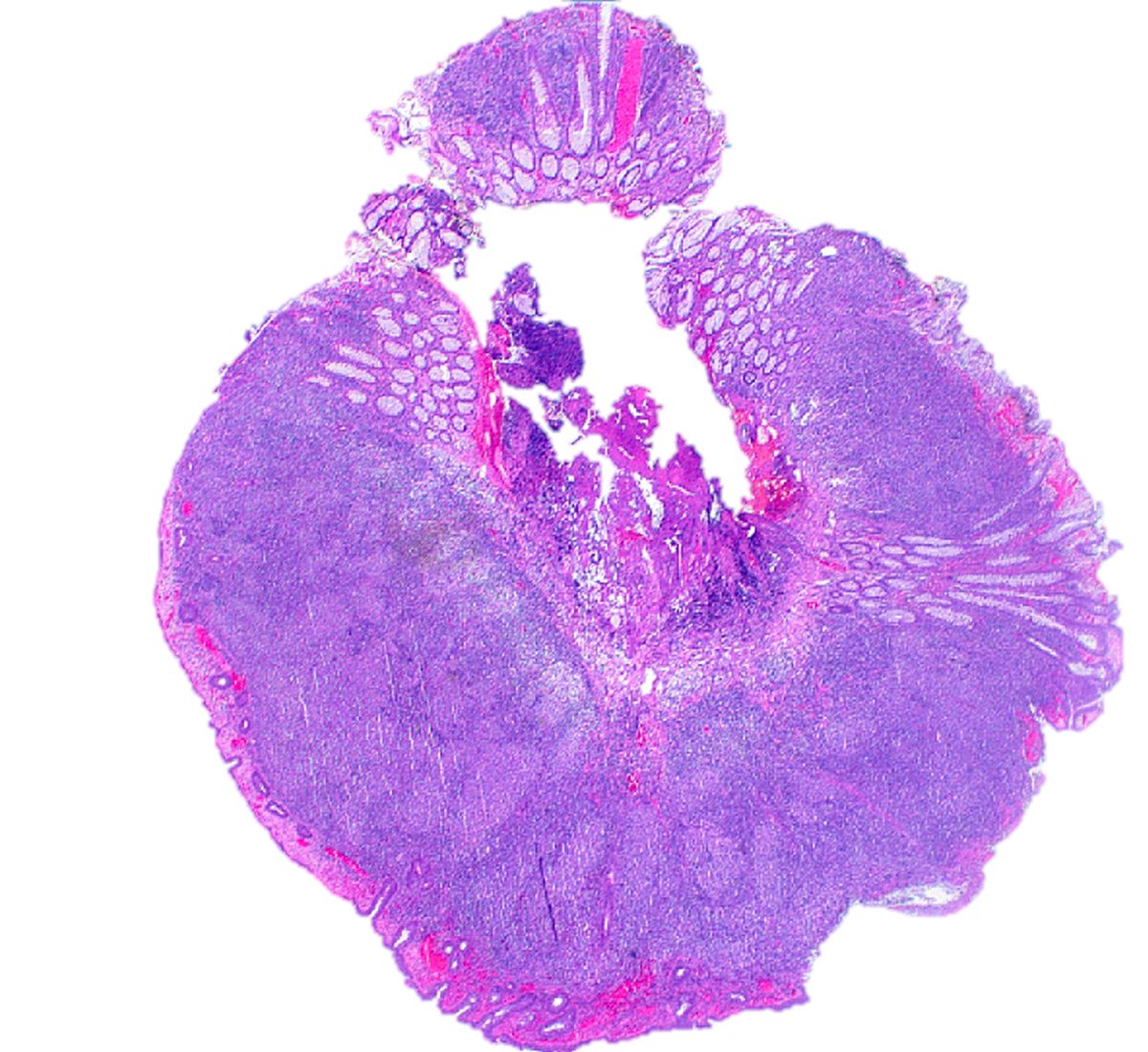 SibaElHussein's tweet photo. Follicular lymphoma, duodenal type➡️Follicular dendritic cell meshworks (CD21/CD23/CD35+) are pushed to the periphery of the neoplastic follicles (“HOLLOW” meshworks), in contrast to preserved meshworks usually seen in nodal/systemic FL #hemepath #pathtwitter #lymsm #MedTwitter https://t.co/fWxz4CZ1GM