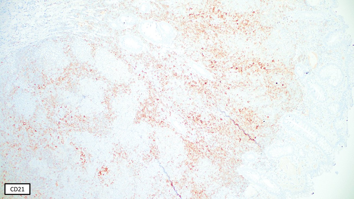 SibaElHussein's tweet photo. Follicular lymphoma, duodenal type➡️Follicular dendritic cell meshworks (CD21/CD23/CD35+) are pushed to the periphery of the neoplastic follicles (“HOLLOW” meshworks), in contrast to preserved meshworks usually seen in nodal/systemic FL #hemepath #pathtwitter #lymsm #MedTwitter https://t.co/fWxz4CZ1GM