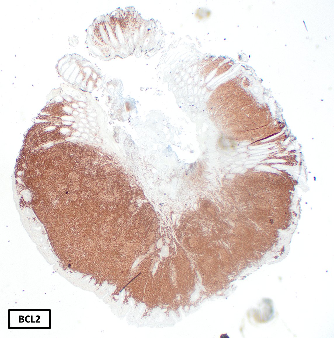 SibaElHussein's tweet photo. Follicular lymphoma, duodenal type➡️Follicular dendritic cell meshworks (CD21/CD23/CD35+) are pushed to the periphery of the neoplastic follicles (“HOLLOW” meshworks), in contrast to preserved meshworks usually seen in nodal/systemic FL #hemepath #pathtwitter #lymsm #MedTwitter https://t.co/fWxz4CZ1GM