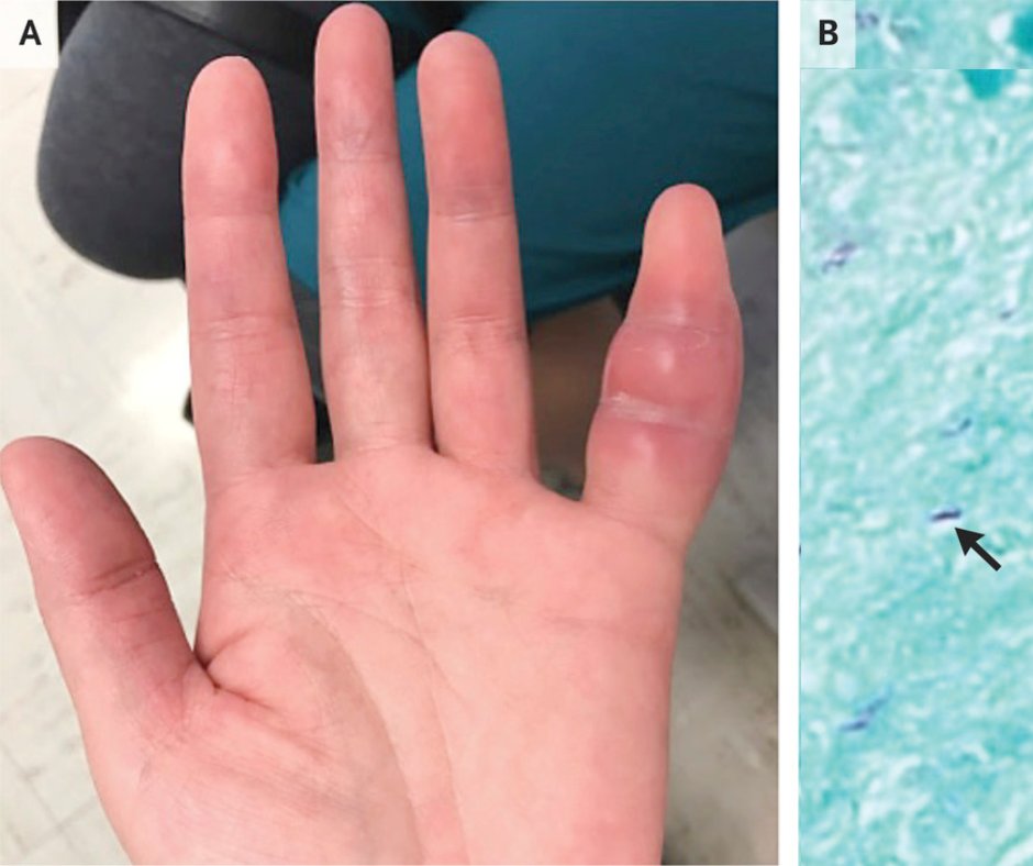 RevistaMSP's tweet photo. #ImagenDelDíaMSP I Tuberculosis en el #dedo: rara forma de #tuberculosisextrapulmonar. 1 semana de inflamación, no traumatismos y con #lupus en tratamiento. Cultivo de muestra de tejido reveló Mycobacterium tuberculosis.
Crédito: Jennifer Mandal, M.D./Mary Margaretten, M.D. https://t.co/7p8q5jeV7o
