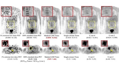 Radiology: Artificial Intelligence (@radiology_ai) on Twitter photo Longitudinal multimodality co-attentional CNN-Transformer achieved high-quality, low-dose whole-body PET images of pediatric patients doi.org/10.1148/ryai.2… <a href="/YanranWangJoyce/">Joyce Yan-Ran Wang</a> <a href="/StanfordDeptMed/">Stanford Department of Medicine</a> #NucMed #AI #ML Longitudinal multimodality co-attentional CNN-Transformer achieved high-quality, low-dose whole-body PET images of pediatric patients doi.org/10.1148/ryai.2… <a href="/YanranWangJoyce/">Joyce Yan-Ran Wang</a> <a href="/StanfordDeptMed/">Stanford Department of Medicine</a> #NucMed #AI #ML