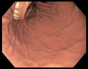 Endoscopic view in the stomach. What would you do?