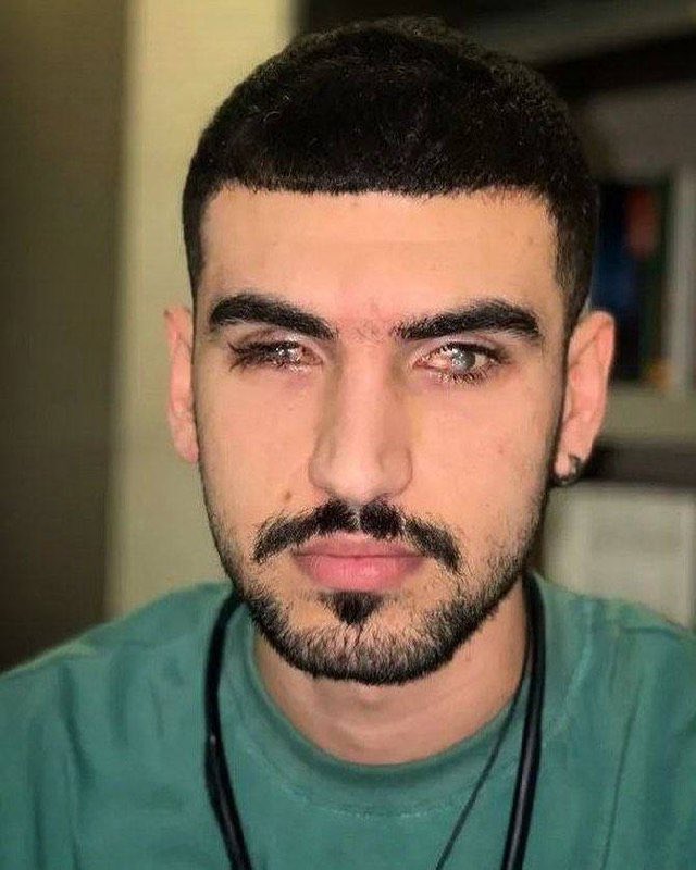 LoabatK's tweet photo. من #متین_منانی هستم. من زنده هستم ولی هر دو چشمم کور شده. ۲۵ سالمه و دانشجوی مهندسی کامپیوتر در ساری هستم یا بهتره بگم بودم . ۲۹ شهریور ۱۴۰۱ آخرین روزی بود که تونستم ببینم! من علاوه بر تحصیل در دانشگاه پیام نور ساری نیمه وقت با برادرم گل آرایی میکردیم تا هزینه های خانواده را تأمین کنیم چون پدرم که جانباز جنگ هست در پی حادثه در حين كار نقاشی ساختمان از کار افتاده شد و مسئولیت مالی خانواده بر دوش من و برادرم افتاد.  
غروب ۲۹ شهریور ۱۴۰۱ بود، برای خرید به مرکز ساری رفته بودم حوالی ساعت ۸ شب به سیل جمعیت حاضر در میدان امام حسین برخوردم، پلیس نوپو و یگان ویژه به سمت جمعیت یورش بردن و من فرار کردم. برای رهایی از ازدحام جمعیت و یافتن راهی برای رفتن به خونه به سمت پارک سبزه میدان دویدم که به محض رسیدن به ورودی ضلع جنوبی پارک صدای چند شلیک از فاصله نزدیک را شنیدم و ناگهان بی اختیار افتادم زمین و سوزش شدیدی در چشمام احساس کردم. دیگه چیزی رو ندیدم و فقط درد و سوزش چشمامو حس میکردم. من هدف گلوله های ساچمه ای از جلو و پشت سرم قرار گرفته بودم و در حالی که غرق در خون بودم دو خانم و یک آقای جوان که از شهروندای حاضر در اون صحنه بودن با دیدن جسم و صورت خون آلود من، منو کشان کشان سوار ماشین شخصی خودشون کردن تا برای مداوای فوری به نزدیک ترین مرکز درمانی ببرن. در این فاصله با پرس وجو از من شماره موبایل یکی از دوستام و همینطور برادرم مبین رو از موبایلم پیدا کردن و جریان مجروح شدنم رو به اونا اطلاع دادن. بعد منو به اورژانس بیمارستان امیرمازندرانی ساری بردن همون موقع دوستم و مبین هم خودشون رو به بیمارستان رسوندن اما متأسفانه نگهبانی اون بیمارستان از پذیرش من خودداری کرد و قصد تماس با پلیس بخاطرحضور من در بیمارستان رو برای بررسی موضوع مجروح شدنم داشت که مبین سریع منو از اونجا خارج کرد و با ماشین خودش به اورژانس بیمارستان بوعلی سینا ساری رسوند. اونجا با مساعدت کادر درمان کمکهای اولیه درمانی جهت جلوگیری از خونریزی و... برای من انجام شد ولی با توجه به شدت جراحات وارد شده به چشمام و همینطور نبود متخصصای مربوطه در اون برهه زمانی و همین طور کافی نبودن تجهیزات چشم پزشکی اون بیمارستان به مبین توصیه کردن سریعا منو با آمبولانس به بیمارستان چشم پزشکی فارابی تهران منتقل کنه، بعد از هماهنگیهای لازم حدود ساعت یک صبح چهارشنبه ۳۰ شهریور من و مبین با آمبولانس عازم تهران شدیم که حوالی ساعت شش صبح در بیمارستان فارابی تهران پذیرش و بستری شدم و بعد از گذشت چند ساعت تحت عمل جراحی در ناحیه دو چشم قرار گرفتم، بعد از سه روز بستری بودن در بیمارستان فارابی با تجویز پزشکای مربوطه از اونجا ترخیص شدم تا بعد از گذشت مدتی امکان جراحی های دیگه فراهم بشه.
الان هشت ماه گذشته، به دلیل از بین رفتن کامل سیستم عصب چشمام، امکان بازگشت بینایی هر دو چشمم برای همیشه از دست رفته. برای درآوردن ساچمه چند جراحی‌ در قسمتای مختلف بدنم انجام شده تا الان. هنوزم تعداد بسیار زیادی ساچمه در سر و صورت، گردن، قفسه سینه، شکم، بازوها و دستام وجود داره.
من شکایتی با عنوان «ایراد صدمه بدنی عمدی» به دادسرای عمومی و انقلاب شهرستان ساری فرستادم و با توجه به وجود ساچمه هایی که از بدنم درآوردن در طی جراحی، مشخصه که ساچمه ها مربوط به اسلحه شاتگان یا همون ساچمه پران بدون خان بوده که خیلی راحت قابل شناسایی هس که این اسلحه در اون شب توسط چه شخص یا اشخاص یا یگانی مورد استفاده قرار گرفته بوده. تمام هزینه های هنگفت جراحی‌های منو  خانواده و برادرم پرداخت کردن. بعد از تمام شدن اقدامات درمانی و قطع امید پزشکا برای بازگشت بینایی من، اکثر اوقات خونه هستم و حالا همه هزینه های درمان و معاش من بر دوش خانواده ام و برادر فداکارم مبین سنگینی میکنه. 
هموطن صدای من باش🥺
#مهسا_امينی‌‌ 
#علیه_فراموشی