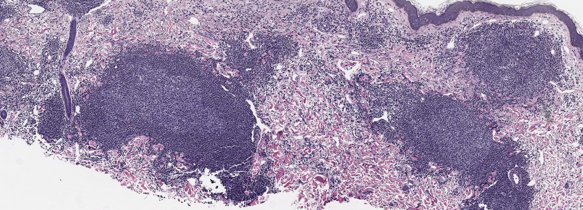 70s♀️neck, R/O neurofibroma
H&E and IHC below
Kappa/Lambda ISH no restriction (not shown)
I think this is reactive, opinions please🙏
#dermpath @mccalmo @HENRYY_MD @alegru18 @et565 @KMirza @AadilAhmedMD @DiegoMoralesN @sanamloghavi @michi_shinohara @DrAldehyde @BDavidDermpath