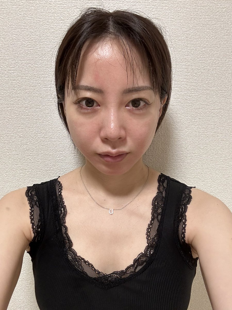 uran_awawasabi's tweet photo. 私がやったとこの傷跡24時間後こんな感じ。左右差あり。激安だからまぁこんなもんかな...最後にヒント置いときます。 https://t.co/hxkQX3H6bw