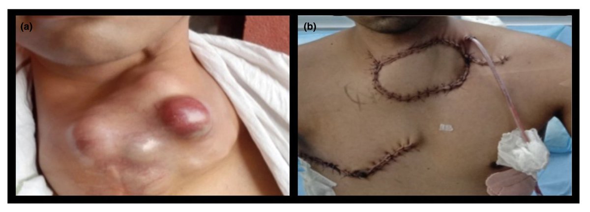 Anaes_Reports's tweet image. Clavicle surgery with contraindications to a thoracic epidural?

Consider bilateral erector spinae plane blocks!

@suryatheja10 @drnishkarsh @drnaveen1984 @RegionalAnaesUK #FreeForAWeek

…-publications.onlinelibrary.wiley.com/doi/full/10.10…