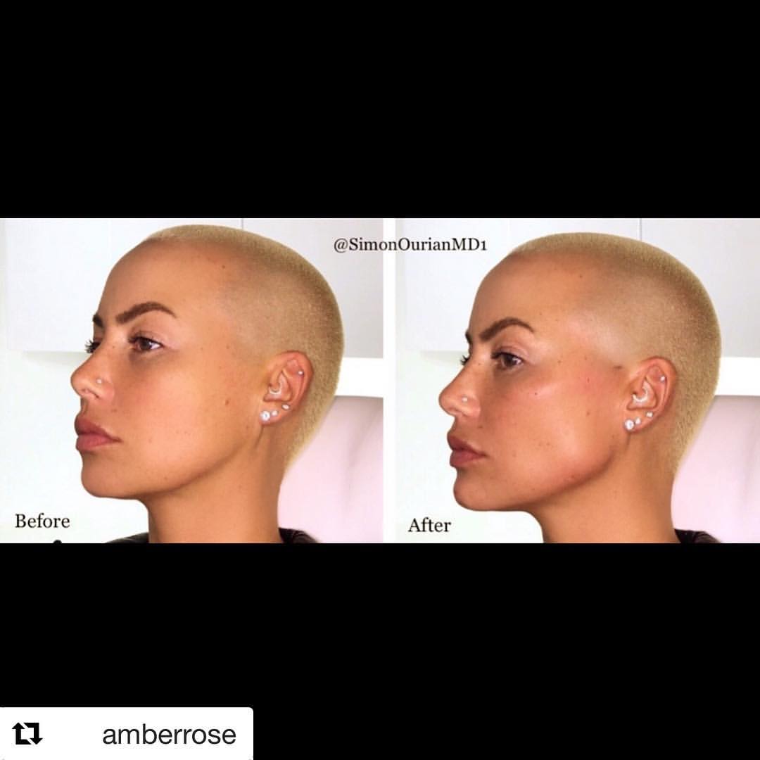 simonourianmd's tweet photo. Non-Surgical Jaw Contouring
#chinaugmentation #chin #doublechin #transformation #makeover #bestdoctorever #bestdoctor #simonourian #epione #beverlyhills #losangeles #amberrose https://t.co/ul1z49qTze