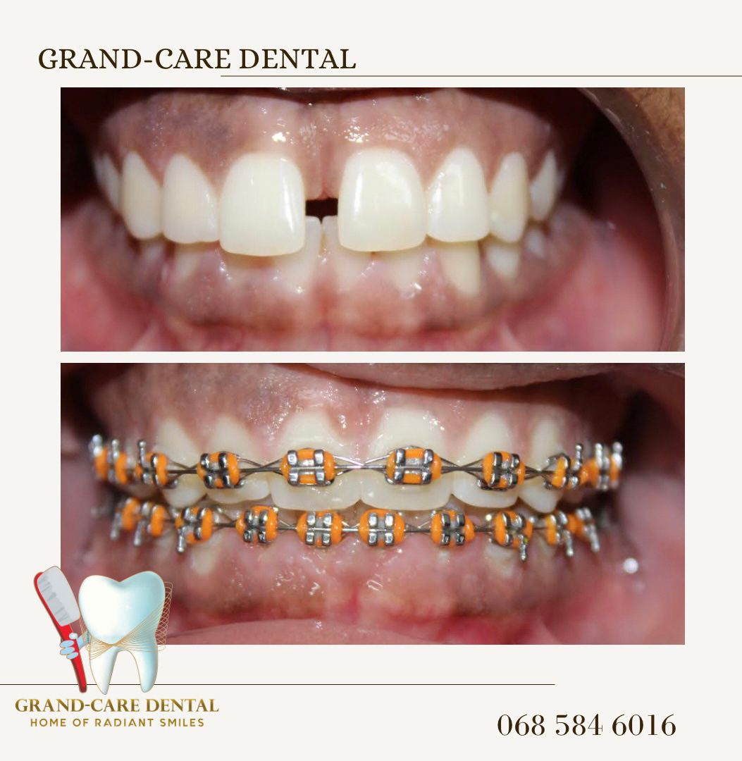 Ndi_Muvenda_'s tweet photo. Do you want to bring back your Smile 😊☺️ Worry Not @JoburgDentist are the best in what they do book your appointment ❤️ https://t.co/qv0uQMaq9w