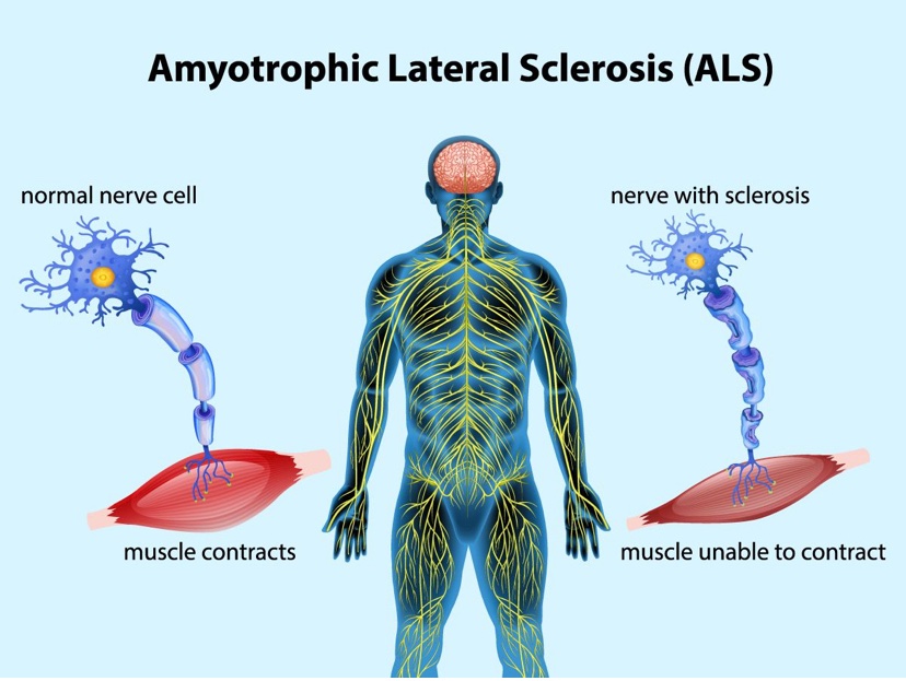 ALS hastalarına umut olacak gen tedavisi onaylandı!!!
Qalsody (Tofersen), süperoksit dismutaz 1 (SOD1) geninde mutasyona sahip amyotrofik lateral skleroz (ALS) hastalarının tedavisi için FDA onayı aldı.
#ALS #genetik #tıbbigenetikderneği