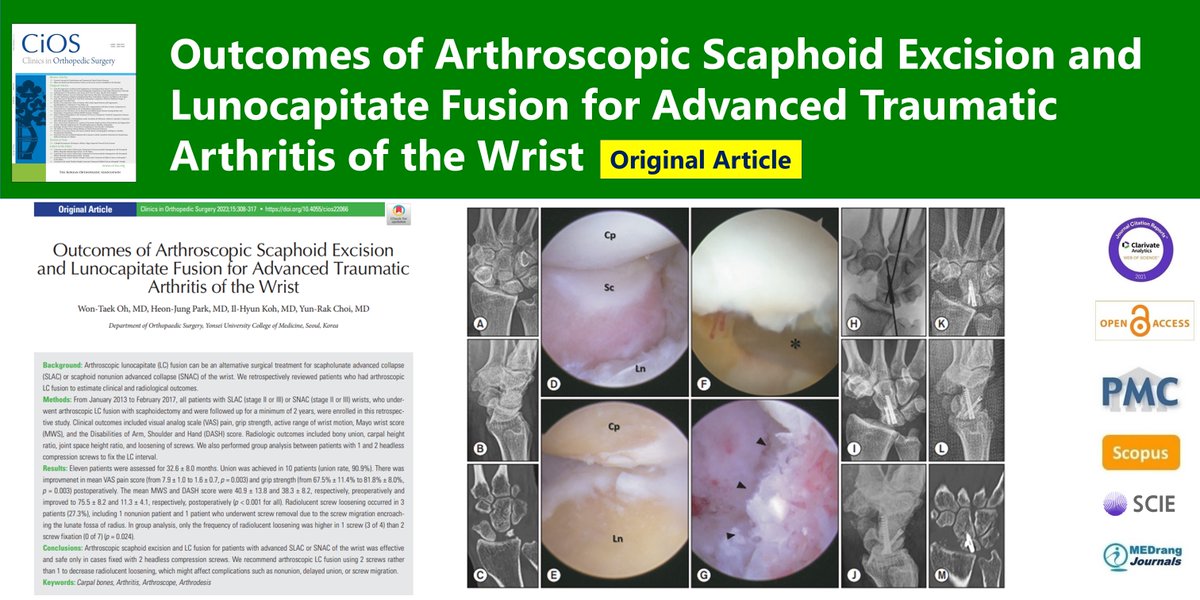 CiOSjournal's tweet photo. Outcomes of Arthroscopic Scaphoid Excision and Lunocapitate Fusion for Advanced Traumatic Arthritis of the Wrist
๐ทhttps://t.co/5AJhKqxuxf
Clin Orthop Surg. 2023 Apr;15(2)Won-Taek Oh
#Carpal_bones #Arthritis #Arthroscope #Arthrodesis https://t.co/nZtmJRbRse