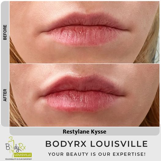 Want fuller, more defined lips? #Restylane #Kysse can give you the look you've always wanted
Book your Appointment Now : rb.gy/bzmyj
#RestylaneKysse #LipFillers #LipAugmentation #DermalFillers #BeautyTreatments #NonSurgical #LipsOnFleek #LipGoals #BeautyEnhancement