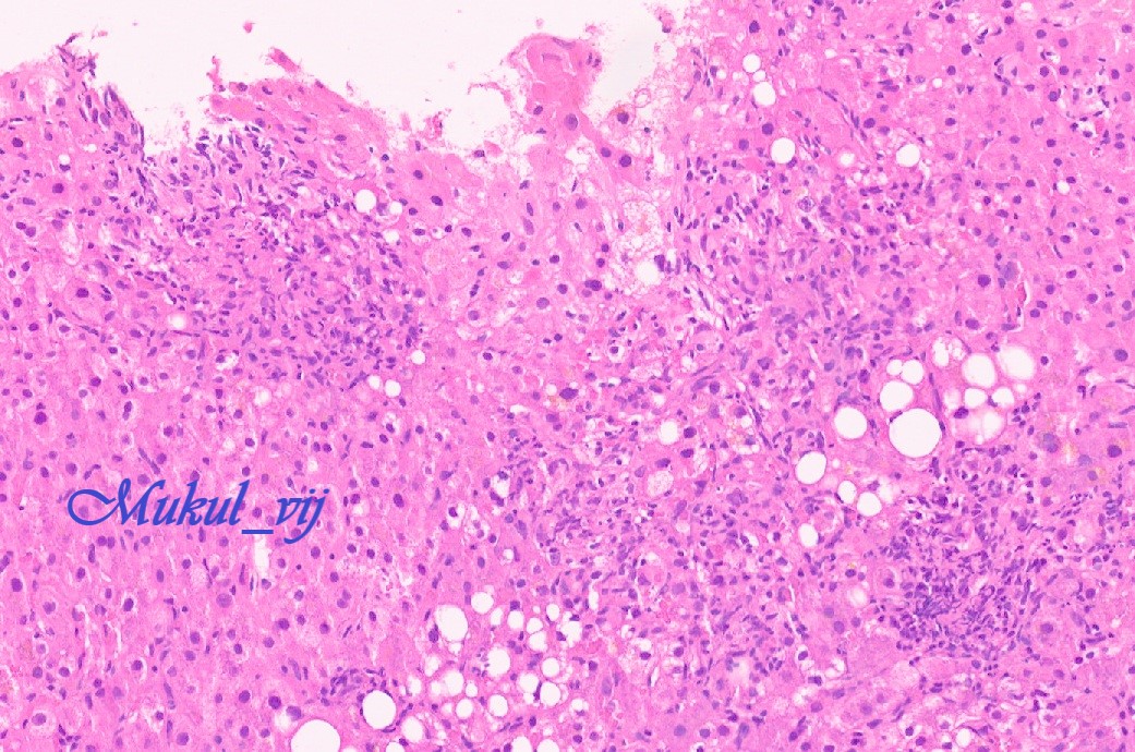Mukul vij md on twitter raredisease bacillus calmette gu rin bcg