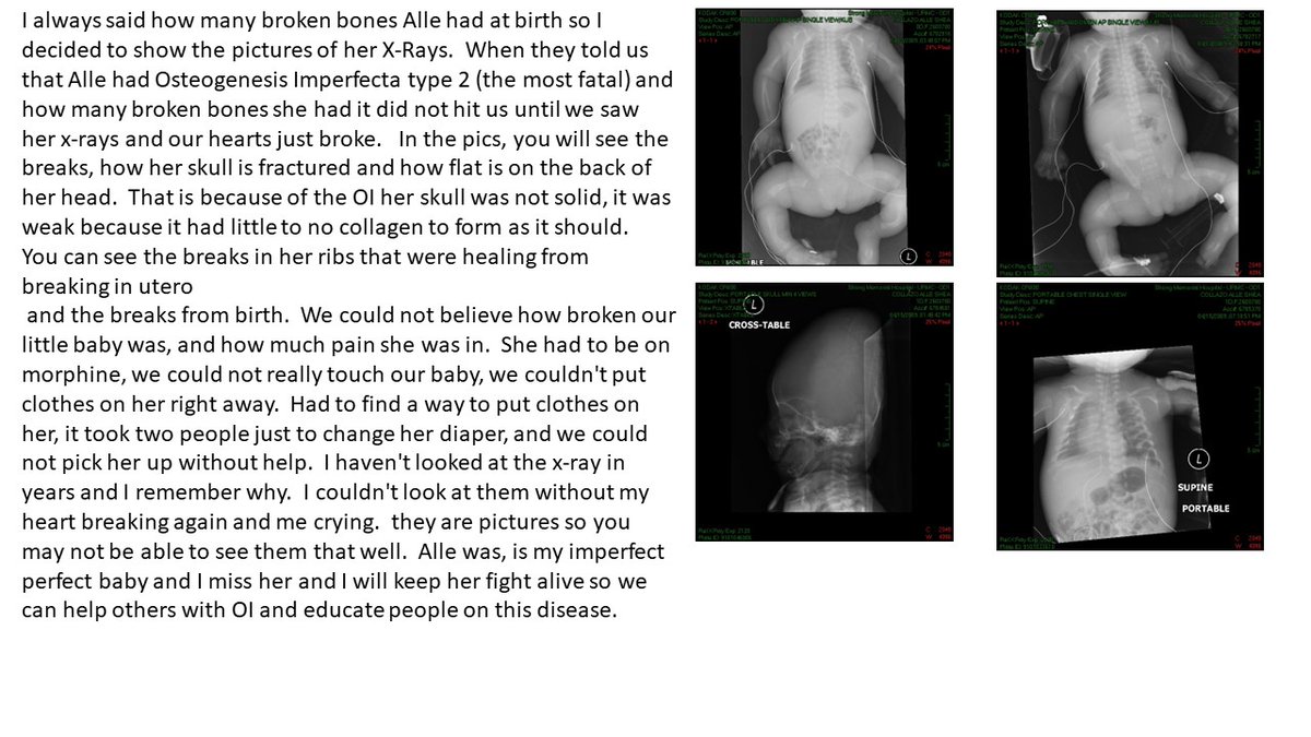 I share Alle's xrays for the first time in 14 years.  I do this for OI Awareness Week, when I first saw them my heart just broke, my baby was so broken.  This is OI the rare brittle bone disease.... At birth, Alle had broken ribs, arm, wrist, legs, and her skull was fractured
