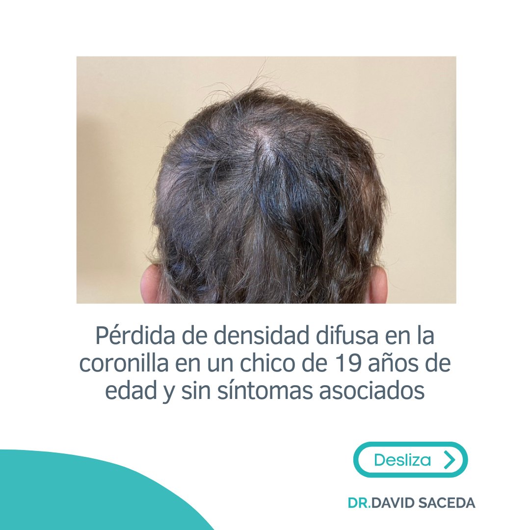 Desaze's tweet photo. Algo indispensable en la consulta de tricología de un dermatólogo es la tricoscopia.🔍 Es una técnica rápida, que no implica molestias y nos aporta muchísima información valiosa sobre el estado del cabello. https://t.co/6YjzZqb7Wq