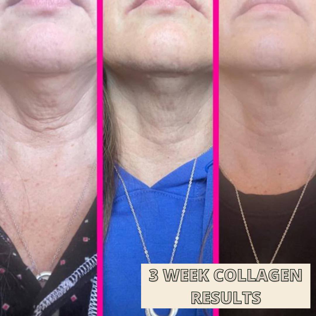 Tamzin_Thornton's tweet photo. ✖️ LETS TALK ABOUT COLLAGEN
I cannot recommend this enough 60 𝐃𝐀𝐘 𝐌𝐎𝐍𝐄𝐘 𝐁𝐀𝐂𝐊 𝐆𝐔𝐀𝐑𝐀𝐍𝐓𝐄𝐄
Collagen benefits including; helping reduce signs of ageing ✔️ reducing the appearance of open pores &amp; scaring ✔️ plumping the skin &amp; giving a glow ✔️ hair &amp; nail growth ✔️ https://t.co/p3eRRr7Zyx