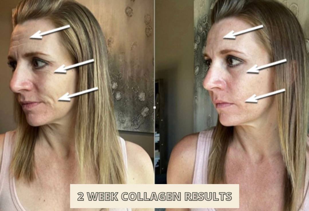 Tamzin_Thornton's tweet photo. ✖️ LETS TALK ABOUT COLLAGEN
I cannot recommend this enough 60 𝐃𝐀𝐘 𝐌𝐎𝐍𝐄𝐘 𝐁𝐀𝐂𝐊 𝐆𝐔𝐀𝐑𝐀𝐍𝐓𝐄𝐄
Collagen benefits including; helping reduce signs of ageing ✔️ reducing the appearance of open pores &amp; scaring ✔️ plumping the skin &amp; giving a glow ✔️ hair &amp; nail growth ✔️ https://t.co/p3eRRr7Zyx