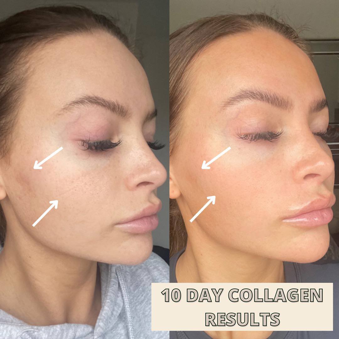 Tamzin_Thornton's tweet photo. ✖️ LETS TALK ABOUT COLLAGEN
I cannot recommend this enough 60 𝐃𝐀𝐘 𝐌𝐎𝐍𝐄𝐘 𝐁𝐀𝐂𝐊 𝐆𝐔𝐀𝐑𝐀𝐍𝐓𝐄𝐄
Collagen benefits including; helping reduce signs of ageing ✔️ reducing the appearance of open pores &amp; scaring ✔️ plumping the skin &amp; giving a glow ✔️ hair &amp; nail growth ✔️ https://t.co/p3eRRr7Zyx