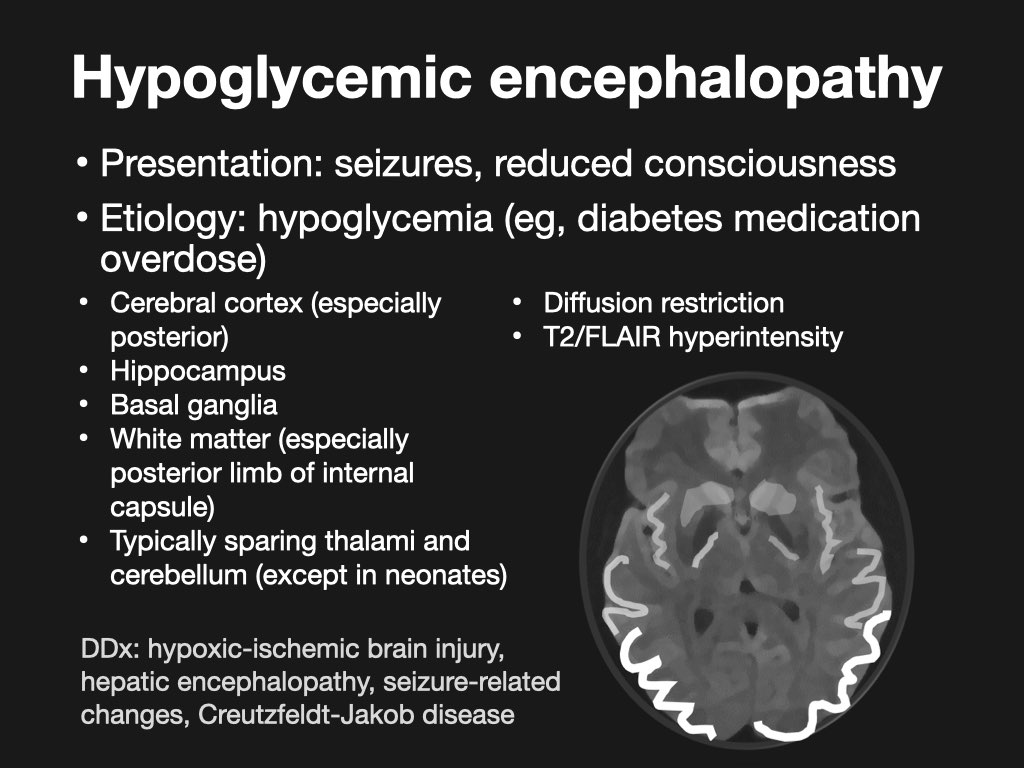 Iamnazahatpasha's tweet photo. #Neurometabolicdisorder
#Hypoglycemicencephalopathy
#Radiopaedia https://t.co/InUs4kEDFy