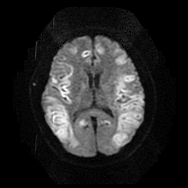 Iamnazahatpasha's tweet photo. #Neurometabolicdisorder
#Hypoglycemicencephalopathy
#Radiopaedia https://t.co/InUs4kEDFy