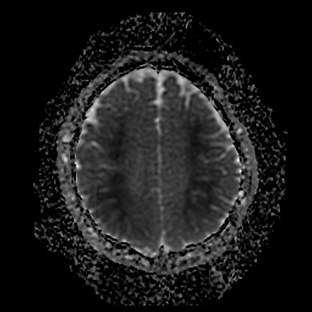 Iamnazahatpasha's tweet photo. #Neurometabolicdisorder
#Hypoglycemicencephalopathy
#Radiopaedia https://t.co/InUs4kEDFy
