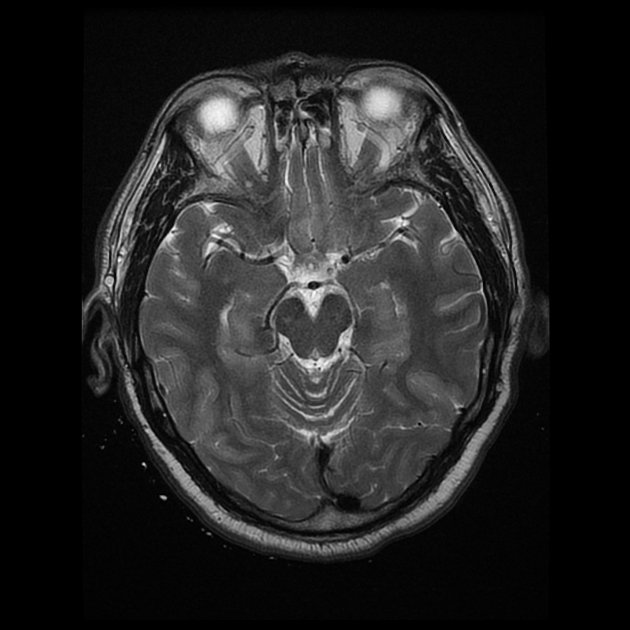 Iamnazahatpasha's tweet photo. #Neurometabolicdisorder
#Hypoglycemicencephalopathy
#Radiopaedia https://t.co/InUs4kEDFy