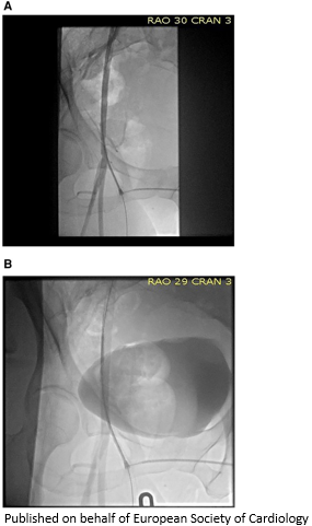 European Society of Cardiology Journals (@esc_journals) on Twitter photo When menstrual cycles trigger #NSTEMI - read about catamenial vasospasm and its treatment bit.ly/429Xr1U
#EHJCaseReports #radialfirst <a href="/aayshacader/">Aaysha Cader</a> <a href="/KardiologieHH/">Erik Rafflenbeul</a> <a href="/ANazmiCalik/">A.Nazmi Calik</a> <a href="/EHJCREiC/">EHJCaseReports Editor-in-Chief</a> <a href="/TJ_Yeo/">Tee Joo YEO</a> <a href="/Phiso_de/">Philipp Sommer</a> <a href="/FarhanaAra/">Farhana</a> When menstrual cycles trigger #NSTEMI - read about catamenial vasospasm and its treatment bit.ly/429Xr1U
#EHJCaseReports #radialfirst <a href="/aayshacader/">Aaysha Cader</a> <a href="/KardiologieHH/">Erik Rafflenbeul</a> <a href="/ANazmiCalik/">A.Nazmi Calik</a> <a href="/EHJCREiC/">EHJCaseReports Editor-in-Chief</a> <a href="/TJ_Yeo/">Tee Joo YEO</a> <a href="/Phiso_de/">Philipp Sommer</a> <a href="/FarhanaAra/">Farhana</a>
