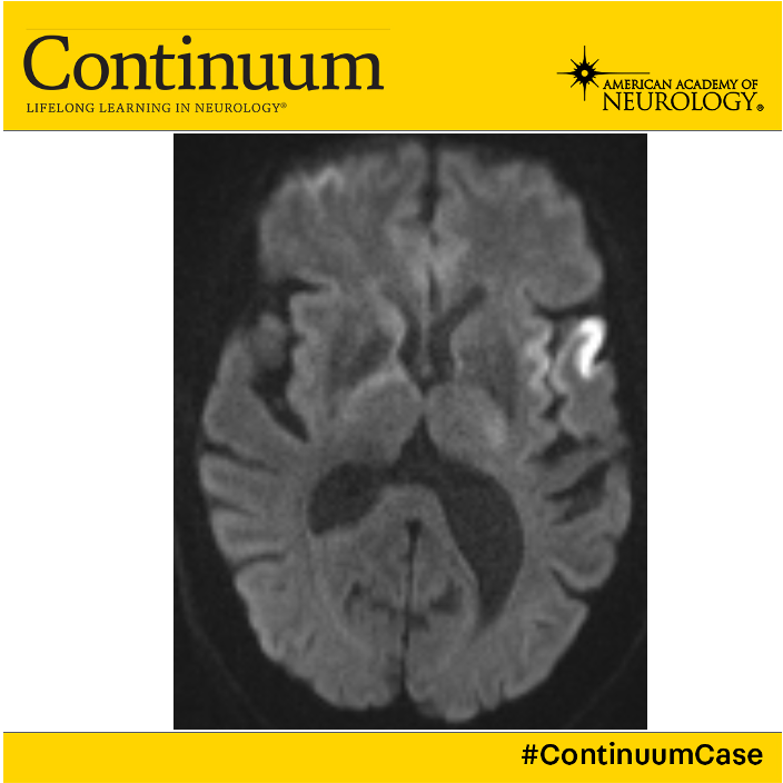 1/
43 yo woman w/ no PMH presents w/ acute onset aphasia and R sided weakness. Head CT is normal, and she is administered IV tPA. CTA reveals a distal M1 occlusion and MT is successful in reperfusion. Post-procedure she has mild WFD.

A #continuumcase about #strokeintheyoung