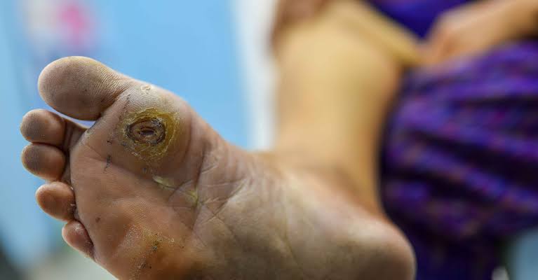 the_beardedsina's tweet photo. Young man noticed his feet wound isn't healing after injury from football

Always notices ants around his urine, pees so much, takes lot of water, gets thirsty easily.

What is this?
What could have caused it? https://t.co/R9xfcwc7yu