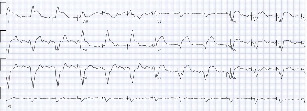A man in his 70s with acute chest pain and paced rhythm.  See what happened.  <a href="/PendellM/">Pendell Meyers</a> 

hqmeded-ecg.blogspot.com/2023/05/a-man-…