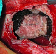 Aortic graft infections are nasty with an operative mortality up to 20% in some series. Come learn how we treat them @CleClinicHVTI with an operative mortality of only 2.6%. Poster presentation at 8:45 this morning @AATSHQ #AATS2023