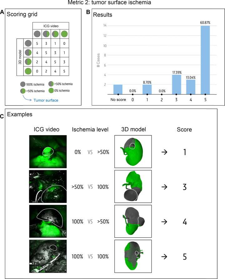 A Novel Three-dimensional Planning Tool for Selective Clamping During PN: Validation of a Perfusion Zone Algorithm 

buff.ly/3RsPGQx 

<a href="/pidebacker/">Pieter De Backer</a> <a href="/CharlesPraet/">Charles Van Praet</a> <a href="/AngeloMottaran/">Angelo Mottaran</a> <a href="/ca_bravi/">Carlo Andrea Bravi</a> <a href="/camilleberquin/">Camille Berquin</a> <a href="/EdwLambert/">Edward Lambert</a> <a href="/StDautricourt/">Stéphanie Dautricourt</a> <a href="/WouterGoeder/">Wouter Goedertier</a> <a href="/KarelDecaestec1/">Karel Decaestecker</a>