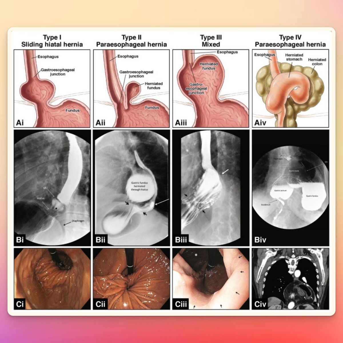 Ppt Endoscopic Diagnosis Of Hiatal Hernia Powerpoint vrogue.co