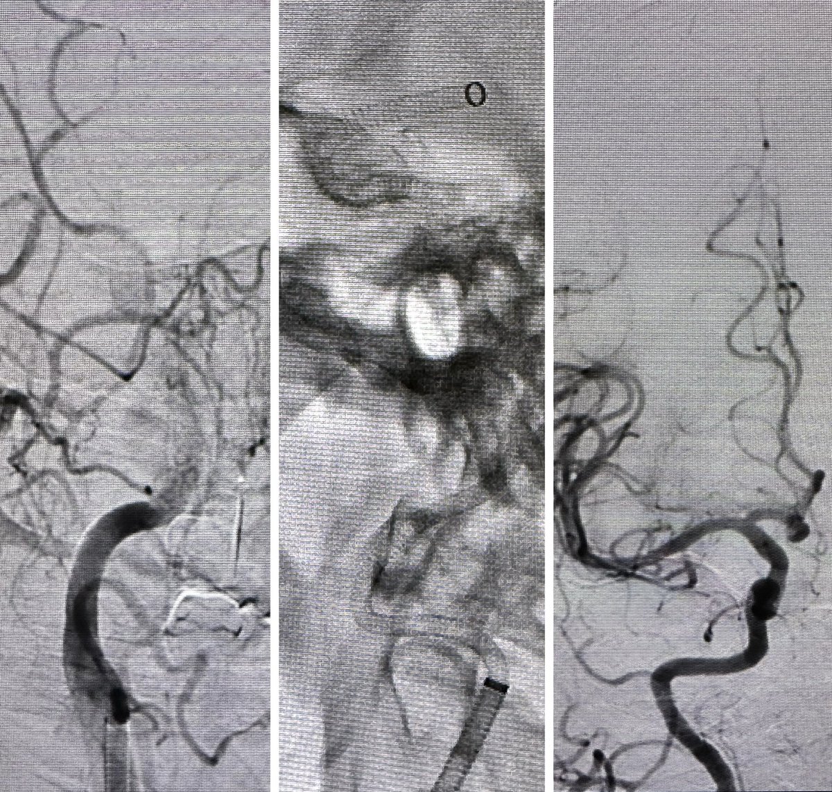 HiPoint 88 at high point! 
We live in an extraordinary time with incredible technologies for stroke surgery.
#LVO #stroke #outcome #TICI3 #Tenzing #Route92 @svinsociety @cvsection @SNISinfo