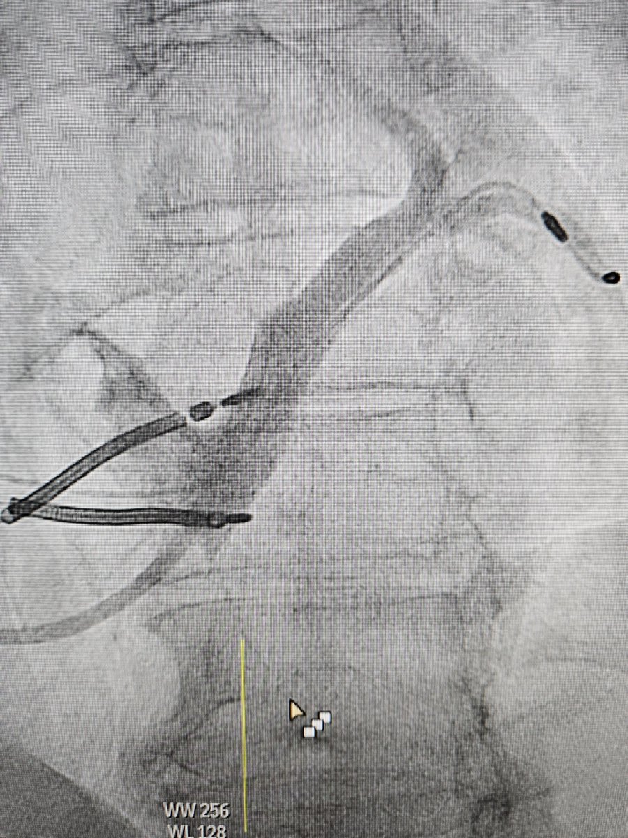 EP_BGM1's tweet photo. When an easy RV revision seemed to never end. Occluded left subclavian, tunneling of a new RV from left, then discovered an insulation defect of the LV with as well new tunneling from left. CS electrode not extractable, but luckily, the target vein could take another lead in. https://t.co/k8vHHCElCG