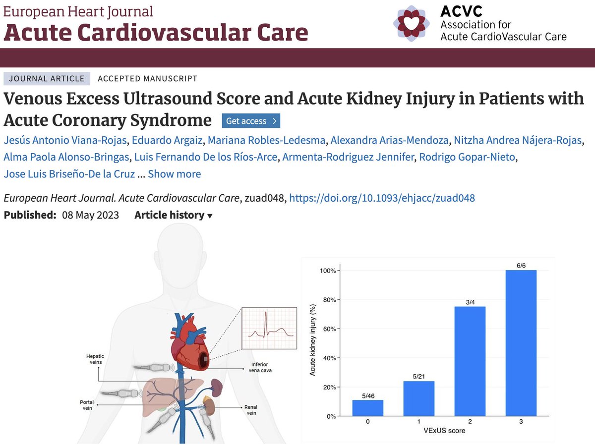Diego Araiza MD (@drdargaray) on Twitter photo Happy to share the results of our study “VExUS and Acute Kidney Injury in patients with Acute Coronary Syndrome”, led by <a href="/DrAntonioViana/">Toño Viana</a> 
VExUS is strongly associated with AKI in ACS.. Beyond other hemodynamic parameters! 
<a href="/ArgaizR/">Eduardo R Argaiz</a> <a href="/rodrigogopar/">Rodrigo Gopar</a> <a href="/DanielSierraLM/">| Daniel Sierra LM |</a> <a href="/alexariasmx20/">Alexandra Arias</a> Happy to share the results of our study “VExUS and Acute Kidney Injury in patients with Acute Coronary Syndrome”, led by <a href="/DrAntonioViana/">Toño Viana</a> 
VExUS is strongly associated with AKI in ACS.. Beyond other hemodynamic parameters! 
<a href="/ArgaizR/">Eduardo R Argaiz</a> <a href="/rodrigogopar/">Rodrigo Gopar</a> <a href="/DanielSierraLM/">| Daniel Sierra LM |</a> <a href="/alexariasmx20/">Alexandra Arias</a>