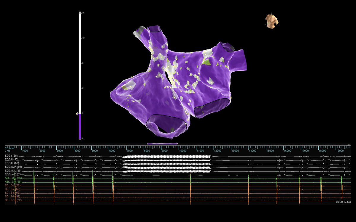educostacardiol's tweet photo. Cardioinhibitory neurocardiogenic syncope treated by Cardioneuroablation: 50 yo, female, no structural CVD, recorrent syncope by assystolic vagal response.
#cardioneuroablation, #cardioritmosjc #hospitalvivalle, #rededor #ensiteabbott, #suprimed, #syncope, #EPeeps, #Cardiotwitter https://t.co/kay0odfXNk