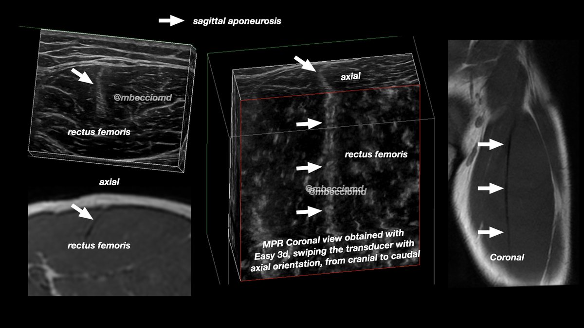 @pompermarioMD YES! Game ended too soon 😅
Described by @akassarjian ajronline.org/doi/pdf/10.221…
Usually MRI is easier to be understood thanks to coronal images which clearly demonstrate retraction of the 'muscle within muscle'. 3d reconstructed US image may be similar. 
Normal architecture