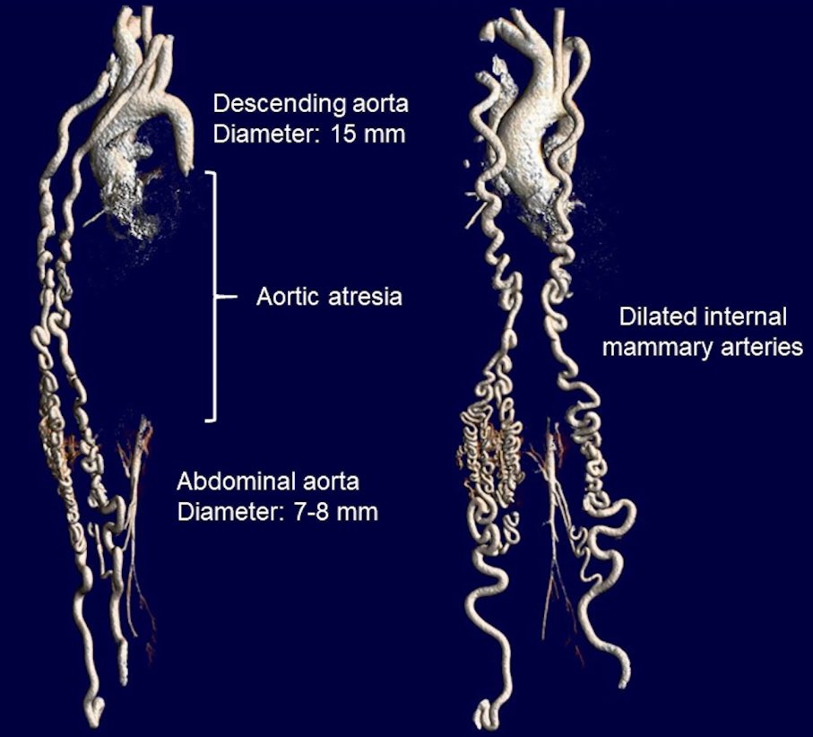 WHERE. IS. THE. AORTA??? Check out our 12:45 case presentation at theater one in the exhibition hall to see how aortic wizard @EricRoselliMD tackled this extreme case of aortic atresia #AATS2023 @AATSHQ