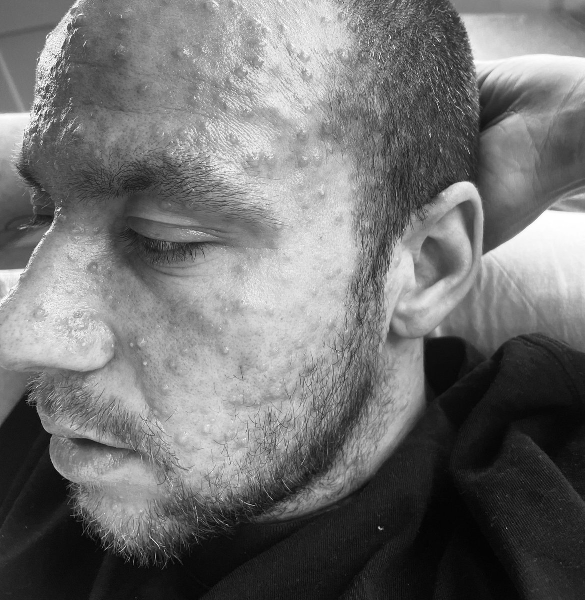 Patrick Olsen on Twitter "Have kids they said, it’ll be fun they said 🤪 Okay so chickenpox is