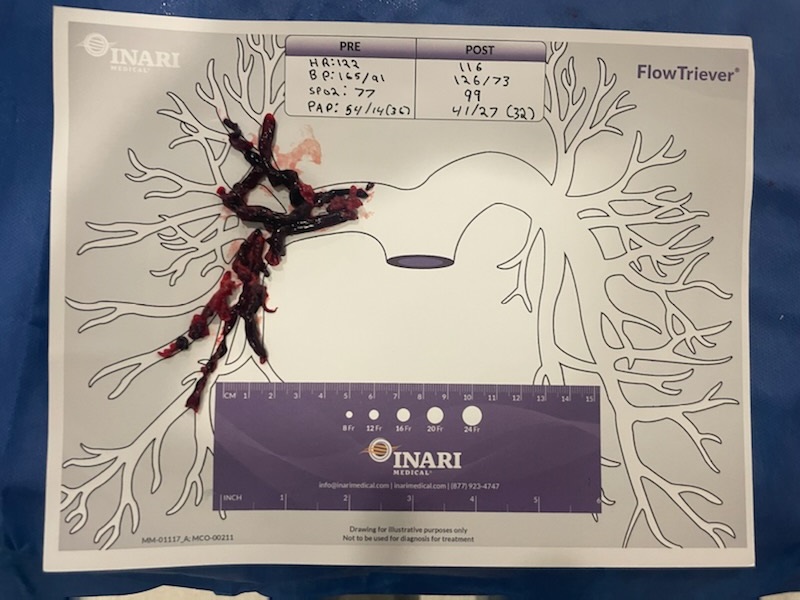 Amit Ramjit (@amitramjitmd) on Twitter photo Successful PE thrombectomy w/immediate improvement using <a href="/InariMedical/">Inari Medical</a> T24 system <a href="/PERTConsortium/">PERT Consortium</a> <a href="/PertPoz/">PERT-POZ</a> <a href="/MedDeviceMatt/">MP</a> <a href="/SIRspecialists/">Society of Interventional Radiology</a> <a href="/SIR_ECS/">SIR ECS</a> #IRad <a href="/IrNyrs/">NYRS IR</a> Successful PE thrombectomy w/immediate improvement using <a href="/InariMedical/">Inari Medical</a> T24 system <a href="/PERTConsortium/">PERT Consortium</a> <a href="/PertPoz/">PERT-POZ</a> <a href="/MedDeviceMatt/">MP</a> <a href="/SIRspecialists/">Society of Interventional Radiology</a> <a href="/SIR_ECS/">SIR ECS</a> #IRad <a href="/IrNyrs/">NYRS IR</a>