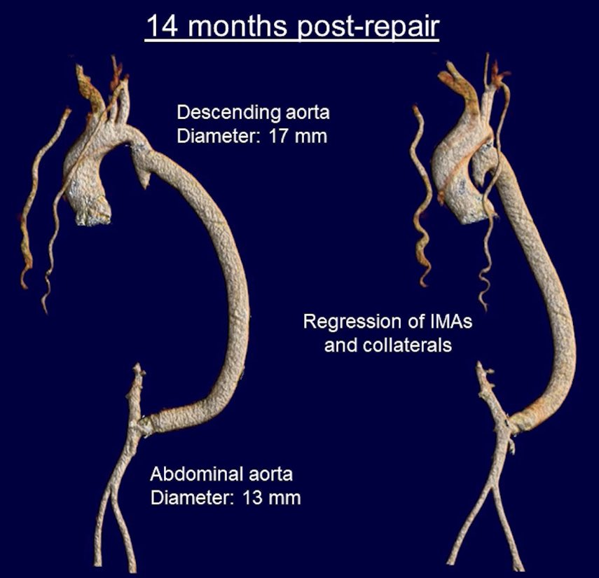 MattThompsonMD's tweet photo. When life gives you lemons, make lemonade. When life doesn’t give you an aorta, @EricRoselliMD will make you a new one #AATS2023 @AATSHQ https://t.co/qUWUS88IwX