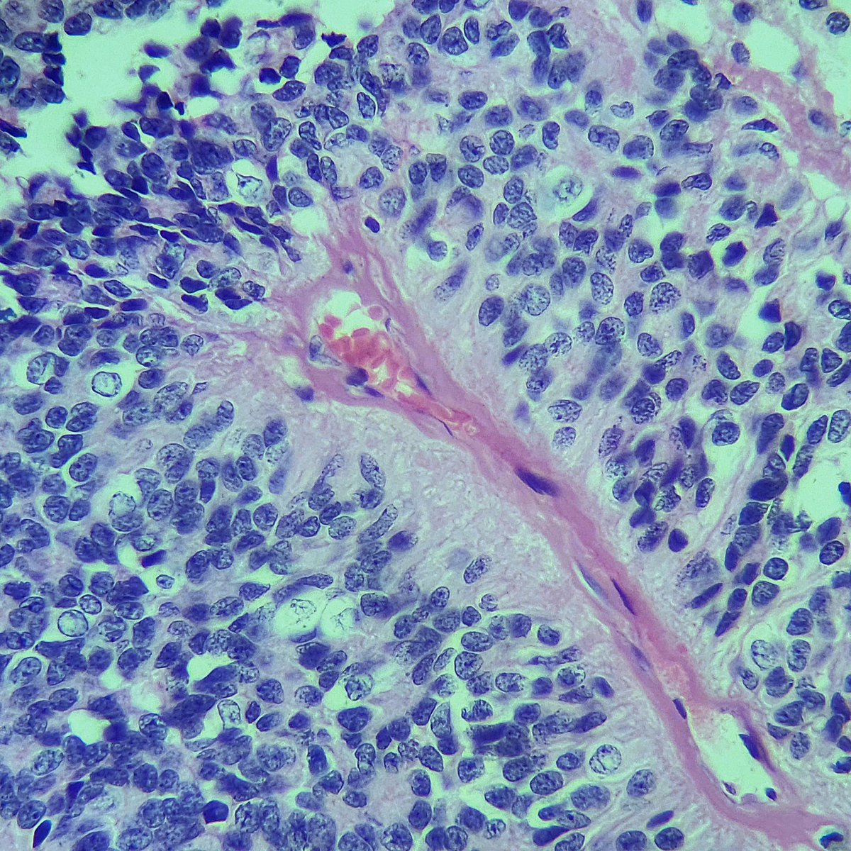 #caseoftheday

50 yo M with a fourth ventricle tumor

#ependymoma NOS, according with the age, it most fit with Group B.

#neuropath