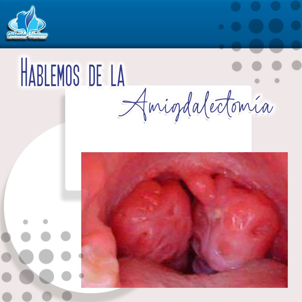 rinocare's tweet photo. ¿Sabes en qué caso se debe indicar una amigdalectomía?

Conoce los detalles aquí https://t.co/lW1V9nspJA https://t.co/snEHw9Dg6P