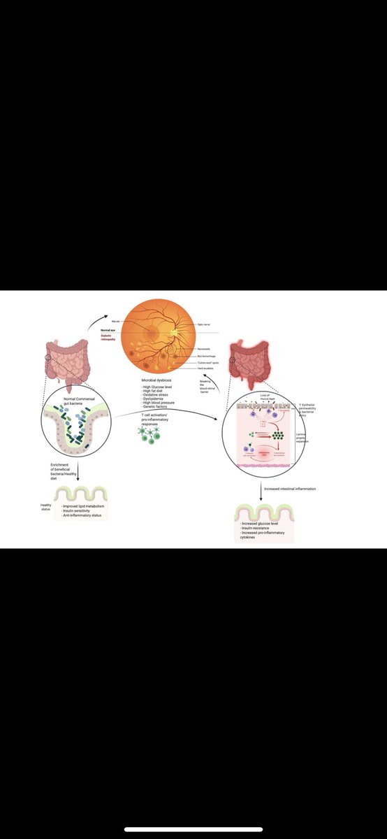 Thrilled for this publication on the "Composition of the gut microbiome, role of diet, lifestyle, and antioxidant therapies in diabetes mellitus and diabetic retinopathy". So much fun designing this illustration for hours and hours on the gut microbiome and diabetic retinopathy