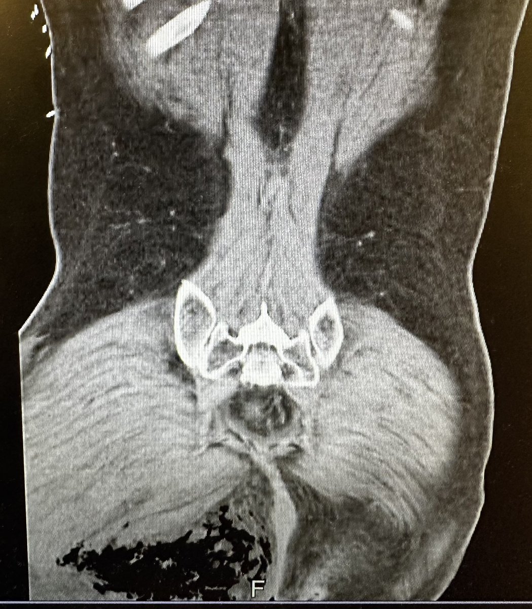 tanudmd's tweet photo. Finishing up my ED rotation and sharing some images I came across. I haven’t seen Fournier’s gangrene since 3rd year med school😳 the crepitus and skin change on exam gave it away and that patient got treated quickly! It’s nice being the first one to guide these patient’s care. https://t.co/GM5eFS3t6z