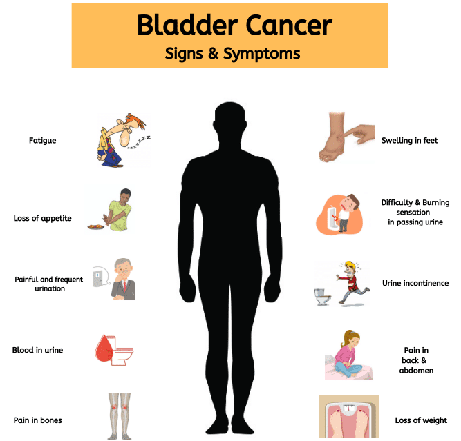 -Blood or blood clots in the urine
-Pain or burning sensation during urination
-Frequent urination
-Feeling the need to urinate many times throughout the night
-Feeling the need to urinate, but not being able to pass urine
-Lower back pain on 1 side of the body
#bladdercancer
